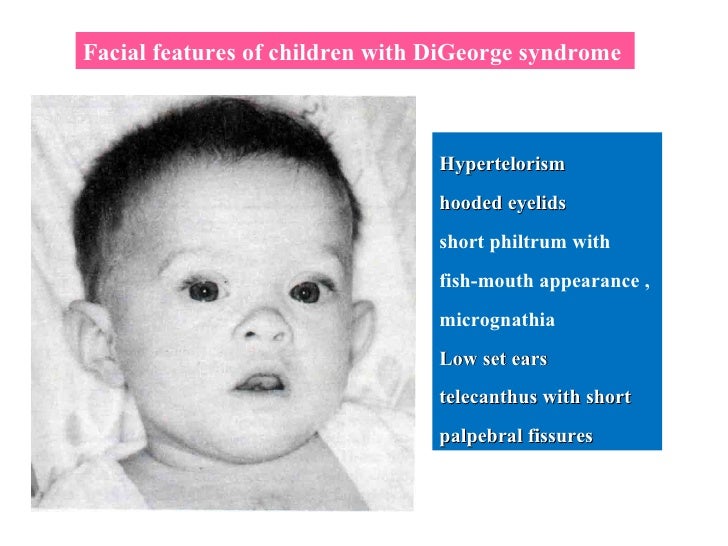 Diagnosing velo-cardio facial syndrome Mature labrador retrievers for sale